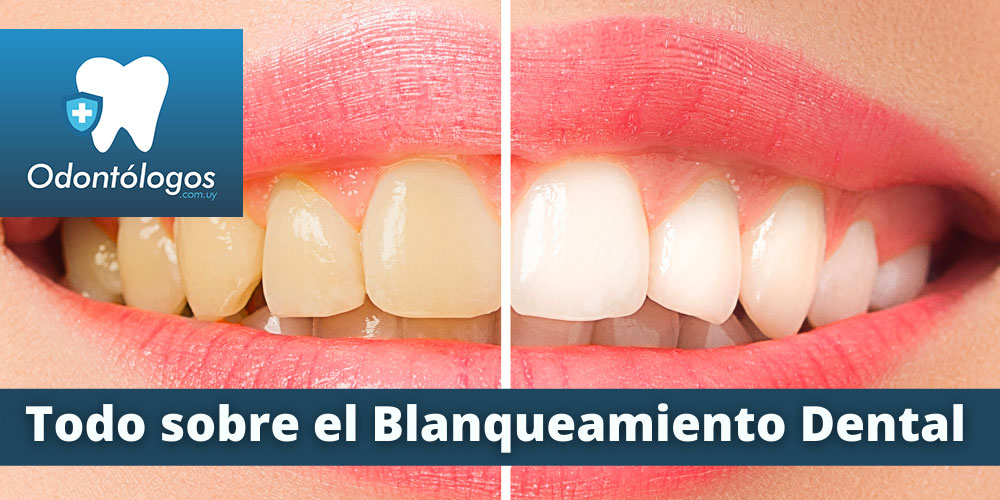Blanqueamiento Dental Uruguay