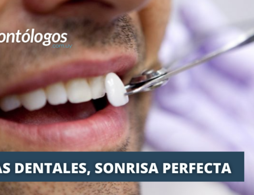 Carillas Dentales: La Solución Cosmética para una Sonrisa Perfecta